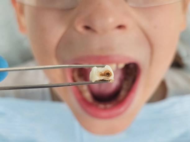 Best Emergency Treatment for Oral Infections in North Fort Lewis, WA